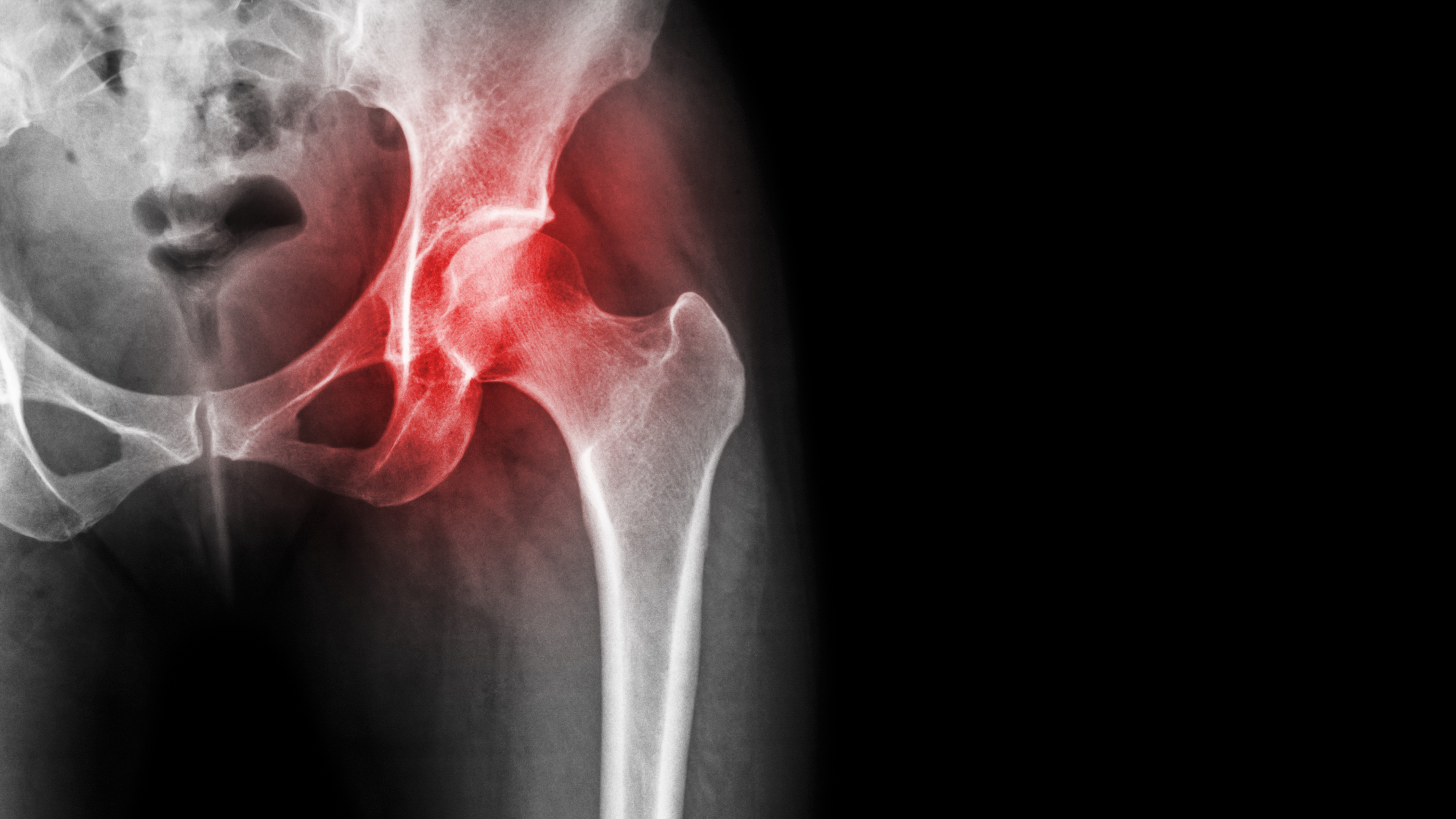 using injections to relieve hip pain after car accident